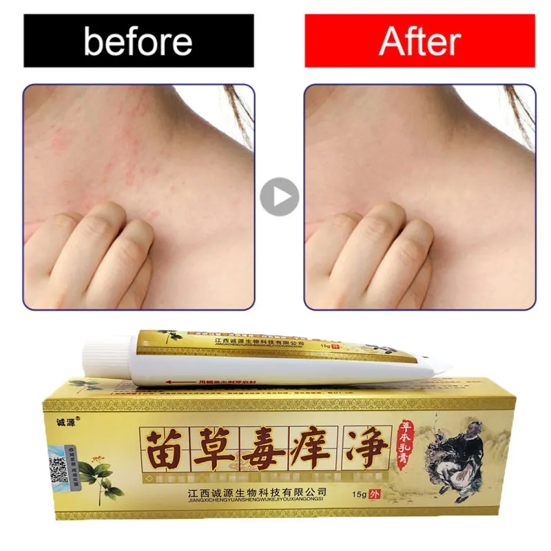 

Atopic DermatiTis Cream Herbal Effective Antibacterial Cream Psoriasis Ointment Dermatitis Eczematoid Eczema Ointment