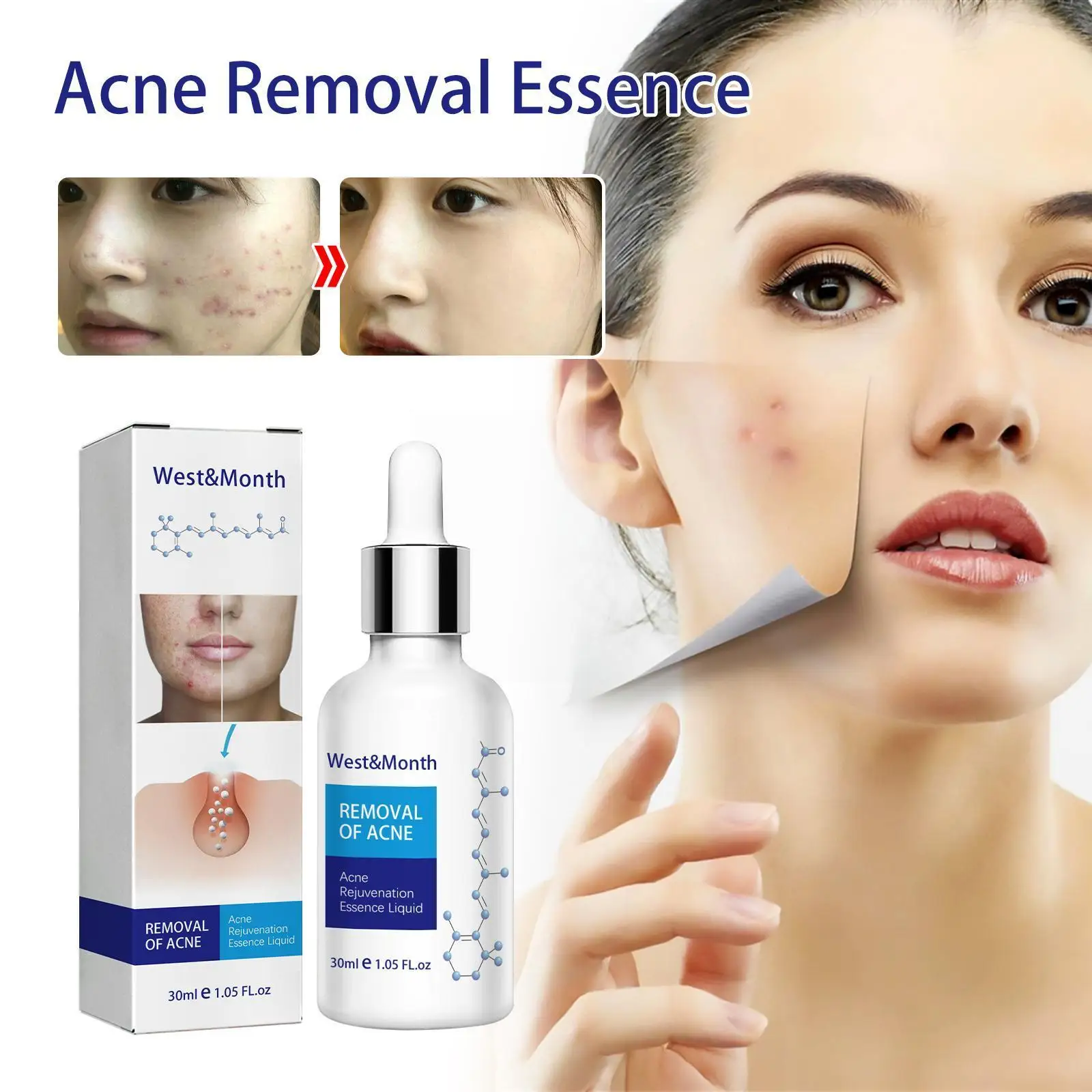 

30ml Acne Treatment Essence Acne Scar Removal Liquid Moisturizing Care Spots Face Whitening Care Face Acne Skin Essence L0a5