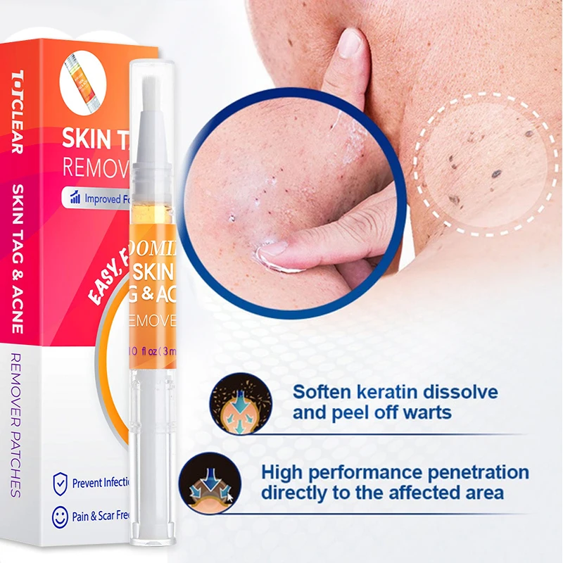 Флуоресцентная ручка для удаления бородавок с кожей жидкая лечения папилломы 1