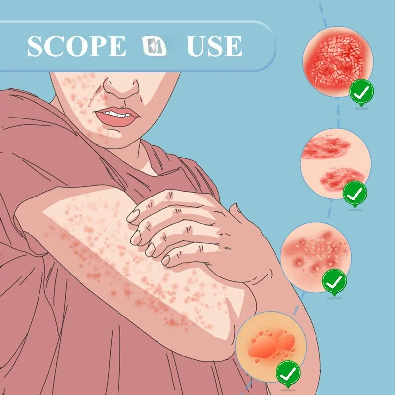 Пластырь для лечения экземы лечение псориаза тинея ингибитор дерматита грибка