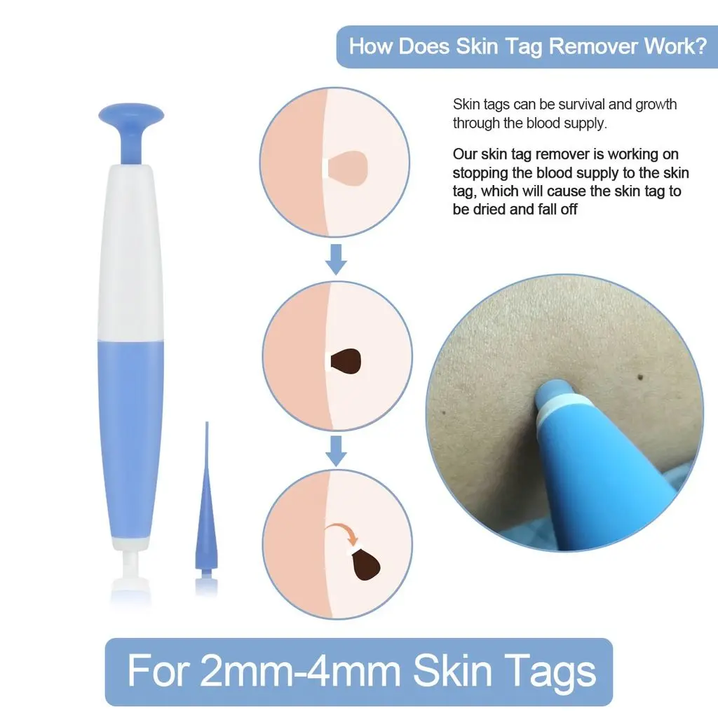 

Auto Band Non Toxic Face Care Mole Wart Tool Blue Skin Tag Removal Kit With Cleansing Swabs Home Use Adult