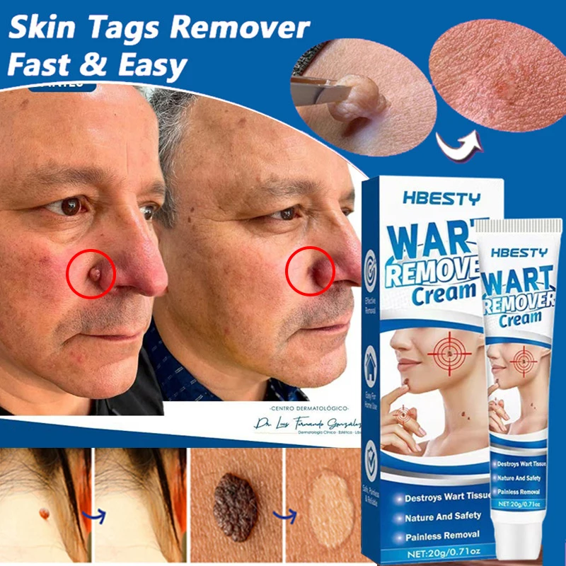 

10 Pcs Body Tag Removal Cream Set Painless Wart Removal Treatment Skin Tag Black Mole Essential Oil Skin Care Cream