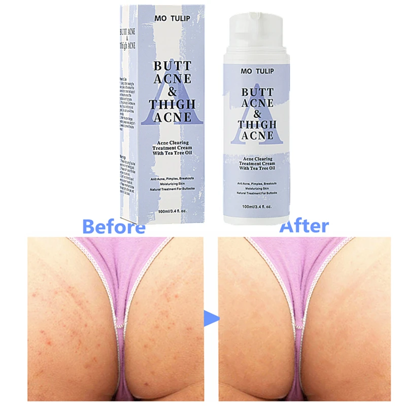 

100ml Butt Acne Clearing Spot Treatment Cream Clears Acne Pimples Zits Razor Bumps and Dark Spots for the Buttocks Thigh Area