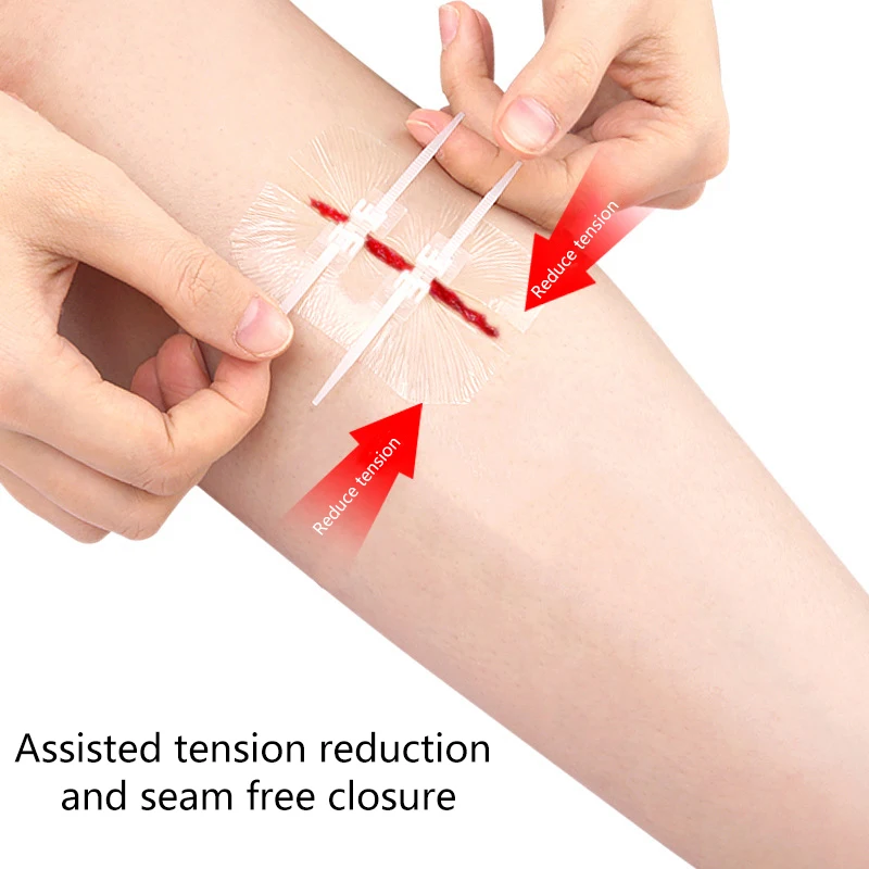 1 шт. завязка на молнии пластырь для закрытия ран быстрый шов уличный портативный
