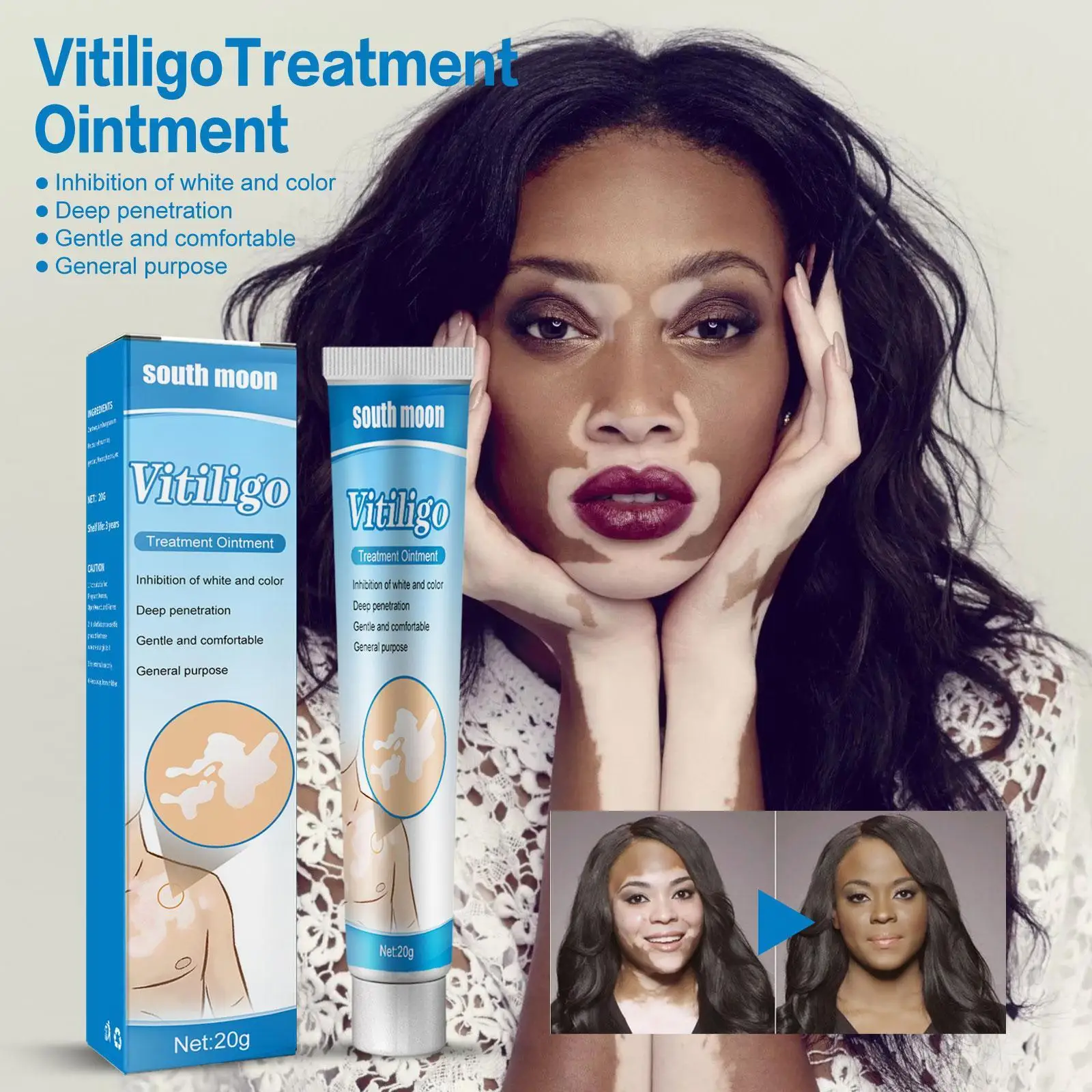 20g Herbal Extract Vitiligo Ointment Remove Ringworm White Removal Treatment Spot Spot White Skin Leukoplakia Cream Disease G9O1