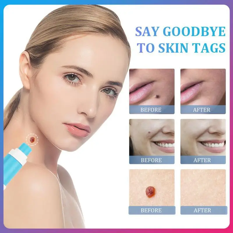 

2-IN-1 Auto Skin Tag Removal Kit Painless Skin Label Mole Acne Wart Removal Pen Set with Cleansing Swabs Facial Beauty Care Tool