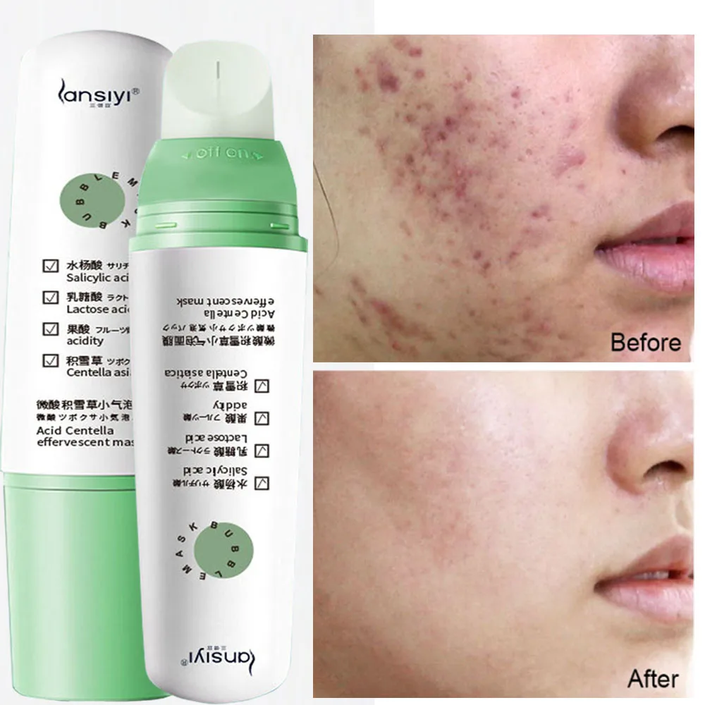 

Salicylic Acid Bubble Mask Acne Treatment Remove Blackhead Shrink Pores Deep Clean Skin Care Moisturizing Facial Beauty Products