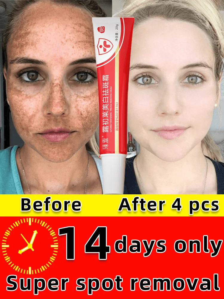 Freckle Whitening Cream Black Dots Melasma Remover Anti Brown Stain Lighten Pigmentation Moisturizing Korean Skin Care Products