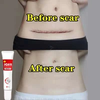 acne scar removal gel fade surgical scald repair cream postpartum whitening dark skin treatment pigmentation smooth skin care