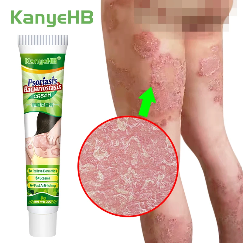 

1pcs Medical Psoriasis Ointment Psoriasis Treatment Cream Inhibit Skin Fungus Anti-itch Eczema Rash Dermatitis Relieve Itch G024