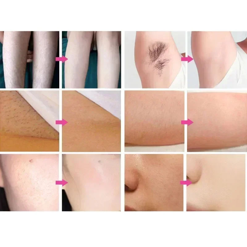 Диодный лазер для удаления волос профессиональная машина новое обновление 3000 Вт