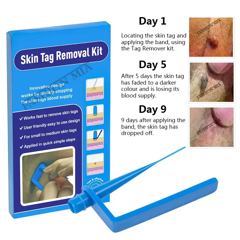 

NEW2023 Blue Set Skin Tag Removal Kit Home Use Mole Wart Remover Equipment Micro Skin Tag Treatment Tool Easy To Clean Skin Care