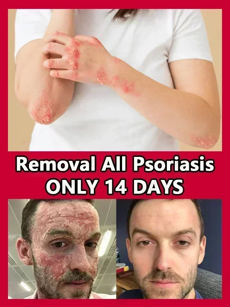 Псориаз экзема экзематоидный дерматит антибактериальный уход за кожей против