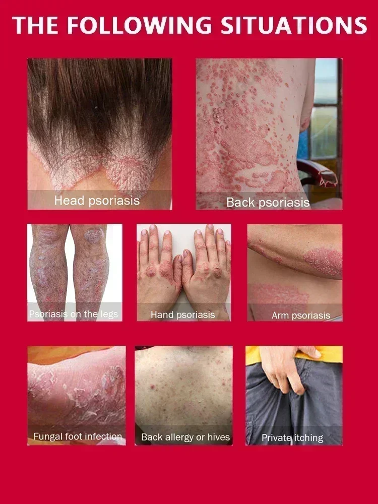 Антибактериальный крем от псориаза опояскивающий пенис экзема герпес