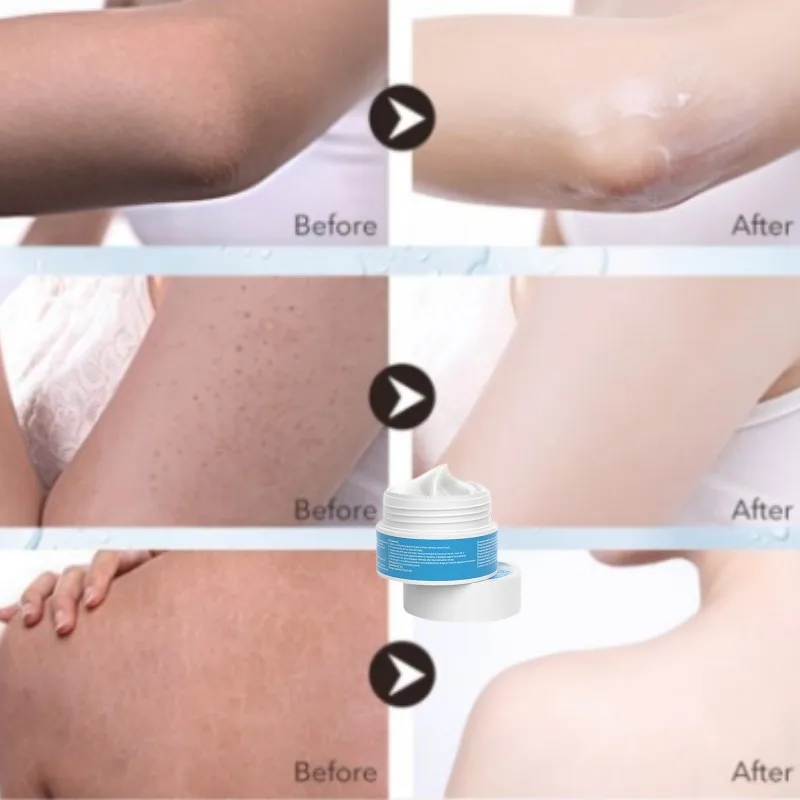 

Vitamin E Chicken Skin Cream Urea Exfoliating Pimple Skin Whitening Moisturizer Strawberry Legs Removal Body Scrub Skin Care