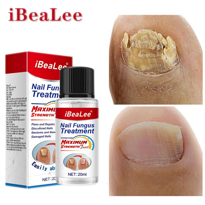 

Эссенция для лечения грибка ногтей iBeaLee 7 дней, сыворотка для ухода за кожей, уход за руками и ногами, удаление грибка ногтей, восстанавливающ...
