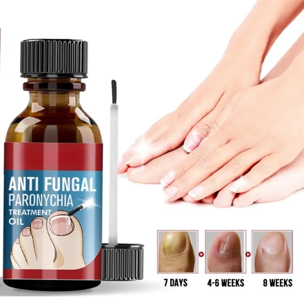 

10 мл Муравьиное грибковое лечебное масло для лечения паронихии жидкость для восстановления ногтей Fangal средство для ухода за ногтями на пальцах