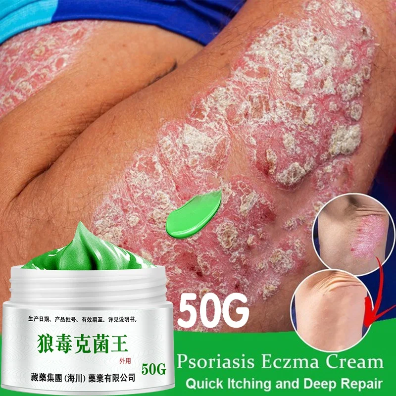 50g Psoriasis Dermatitis Eczematoid Eczema Ointment Anti-Itch Chinese Herb Medical Skin Care Cream | Feet