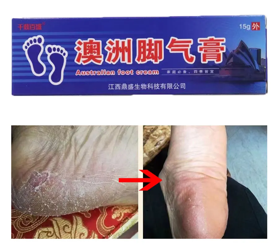 

Beriberi Anti Fungal Foot Cream Treatment Infection Onychomycosis Paronychia Toe Fungus Gel Repair Dry Crack Feet Care