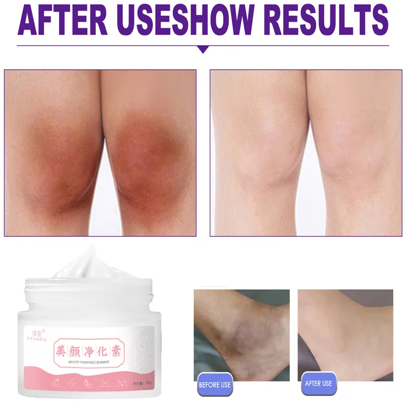 

30g Body Whitening Cream Underarm Legs Knee Elbow Private Parts Brighten Armpit Whitening Cream Remove Dark Spots Skin Car