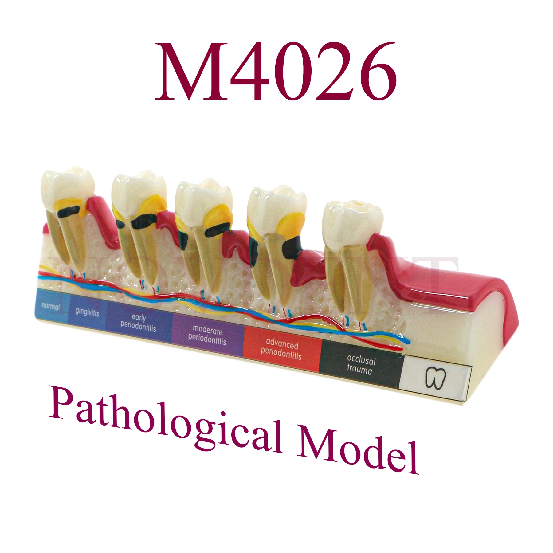 Модель зубов M4026. заболеваний пародонта. Кариес. Классификация процесса. Связь