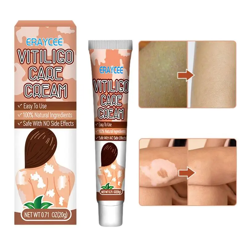 

Vitiligo крем, белые пятна на коже, крем для восстановления пигментации и облегчения, 20 г, уменьшение белых пятен, улучшение эпидермальных ячеек