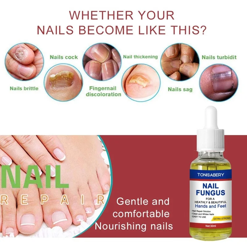 Лечение ногтей от грибка Уход за ногами эссенция против грибковых масла для
