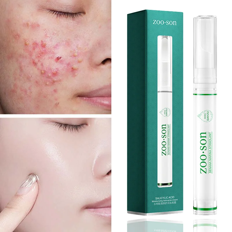 Effective Acne Removal Cream Pimples Scar Removal Facial Cream Oil Control Shrink Pores Whitening Skin Care Beauty Health