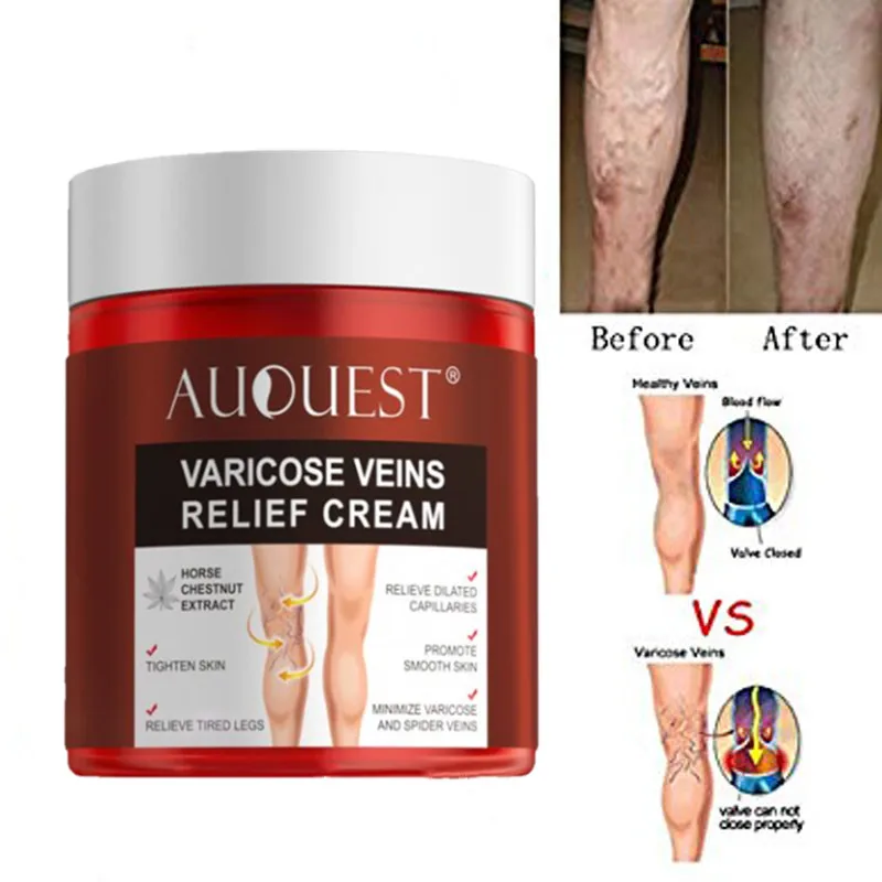 

1Pcs 80g Body Varicose Veins Ointmnet Vasculitis Phlebitis Spider Creams Varicosity Angiitis Removal Herbal Medical Plaster