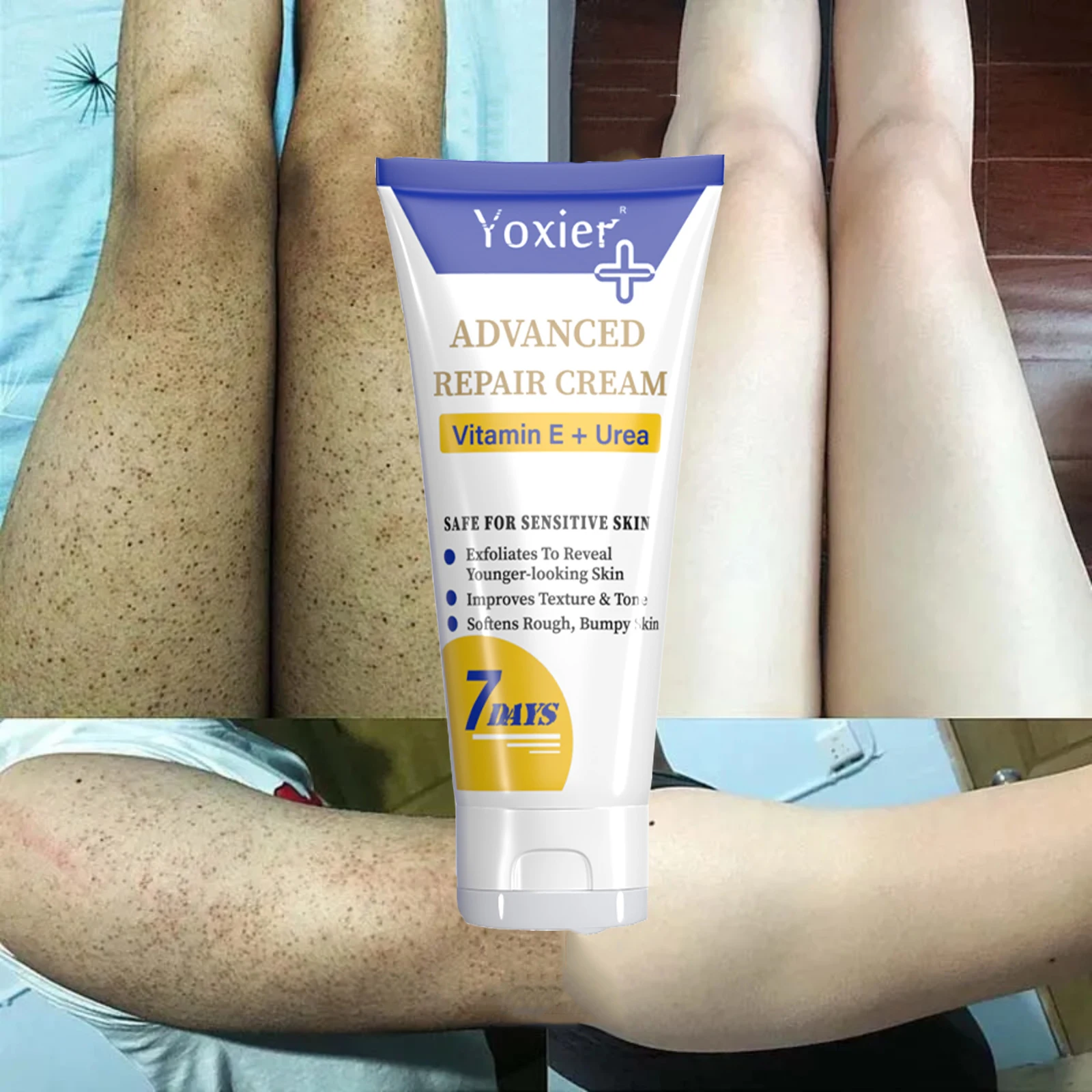 Keratosis Pilaris Repair Treatment Cream Remove Chicken Skin Brighten Body Dark Spots Whitening Moisturizing Smooth Skin Care