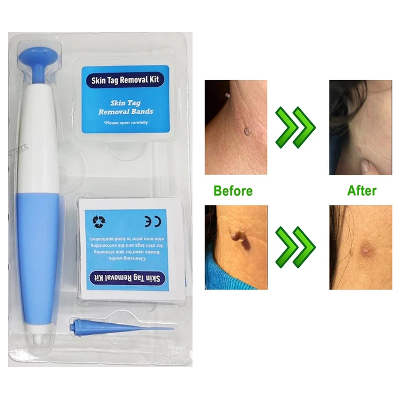 

Auto Band Non Toxic Face Care Mole Wart Tool For Small To Medium Blue Skin Tag Removal Kit With Cleansing Swabs Home Use Adult