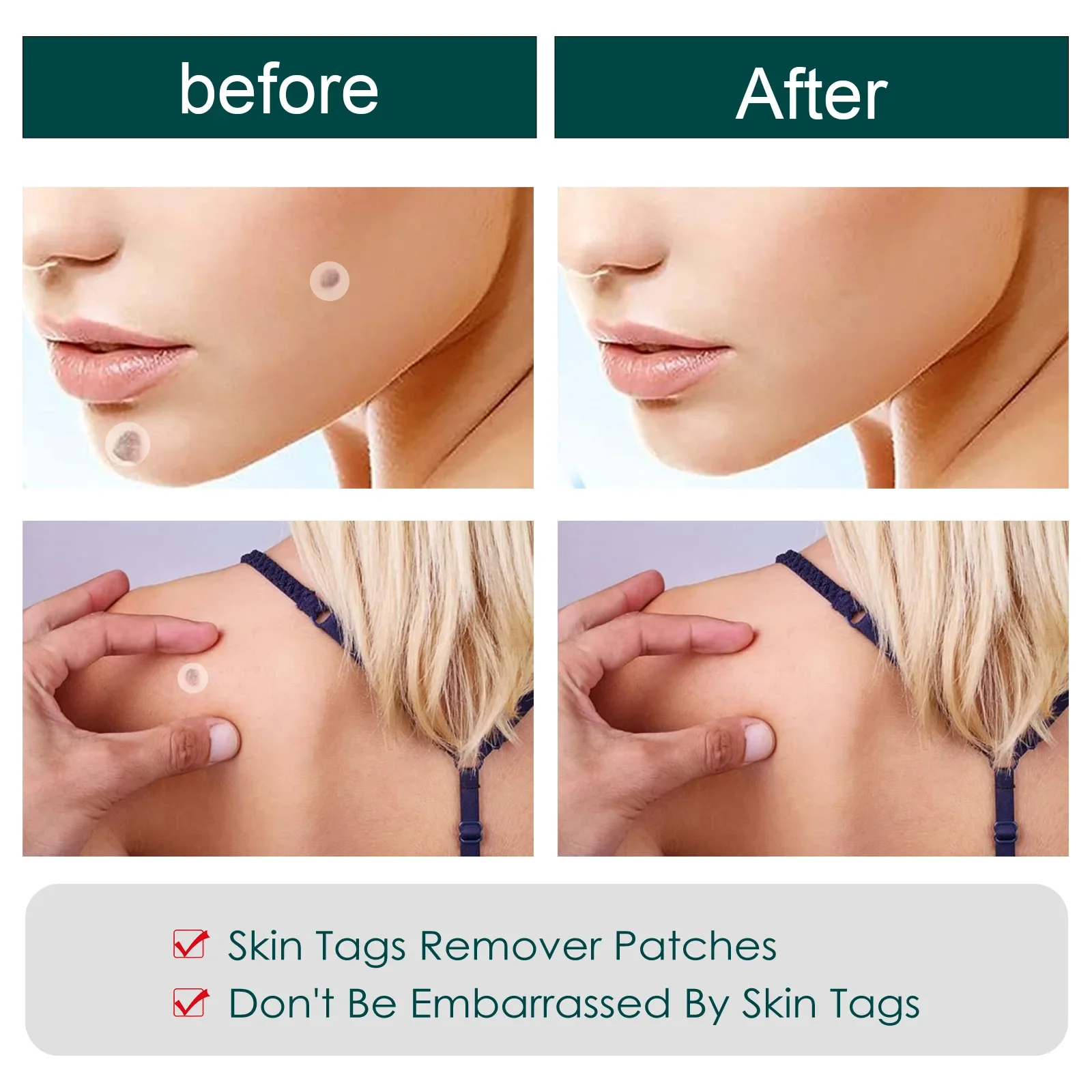 Пластырь для очищения кожи лечение акне утепленный глаз телесные бородавки мяса