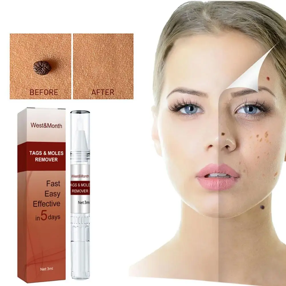 

3ML Wart Removal Mole Remedy Liquid Pen Treatment Papillomas Skin Flat Wart Herbal Cream Genitals Labels Beauty Removing Painle