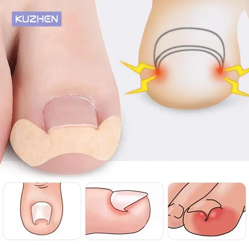 

20Pcs Nail Sticker Toenail Corrector Ingrown Toe Foot Nail Correction Patch