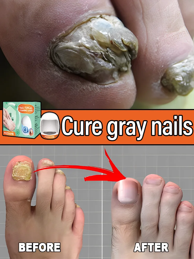 Электронная противогрибковая красота ногтей серого цвета
