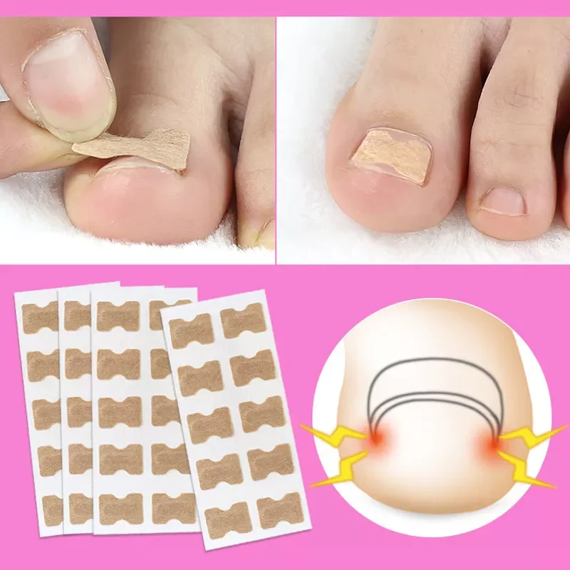 

NEW IN Toenail Corrector Sticker Nail Strip Anti-roll Nail Free Glue Toe Inlay Nail Corrector Patch Correction Stickers Toenail