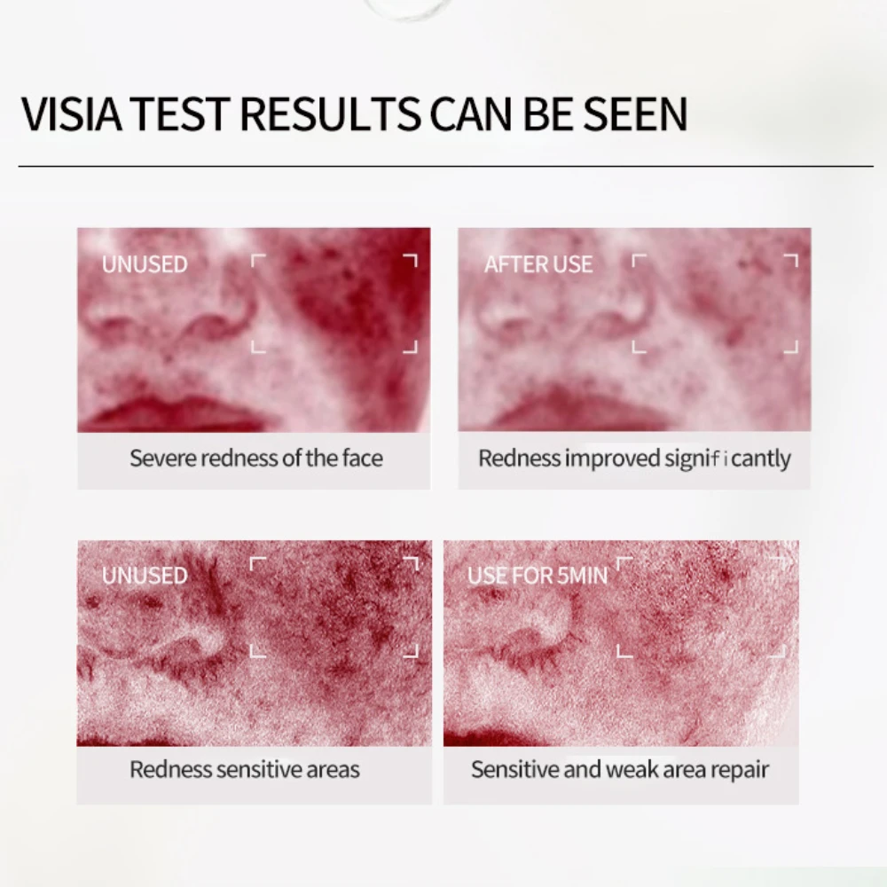 Увлажняющий крем для покраснения кожи лица улучшения чувствительной сухости