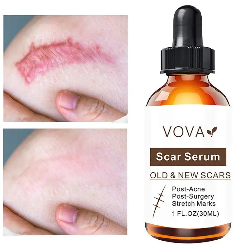 

Натуральная Сыворотка для рубцов, гель для удаления шрамов, увлажняющий Лечебный крем для восстановления кожи после акне