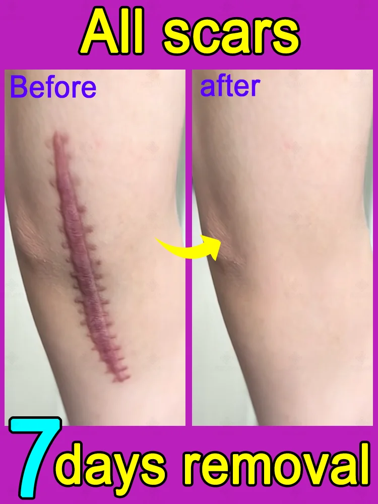 Горячая распродажа! Ремонт шрамов новые и старые шрамы