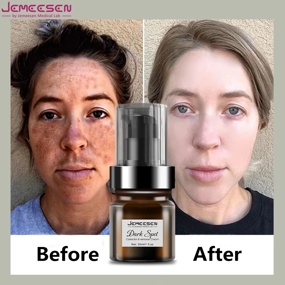 Специальный крем для удаления пигмента меланина коррекция красоты уход за кожей