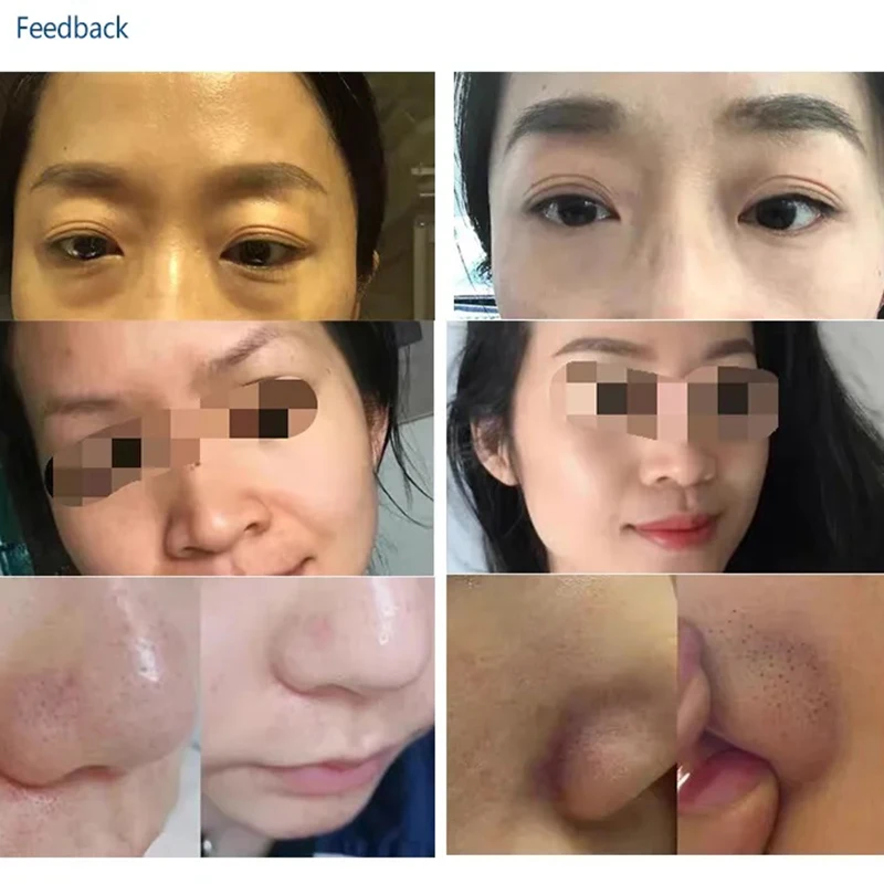 Кислородный аппарат для лица гидравлическая алмазная микродермабразия