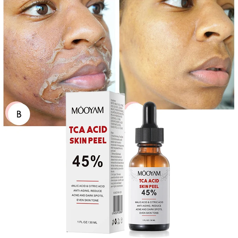 

TCA 45% Chemical Peel Tca Peel Acid Peeling Acid 7-15 Days Delivered Skin Superforce Peeling Pigmentation Acne Scar BrightenSkin