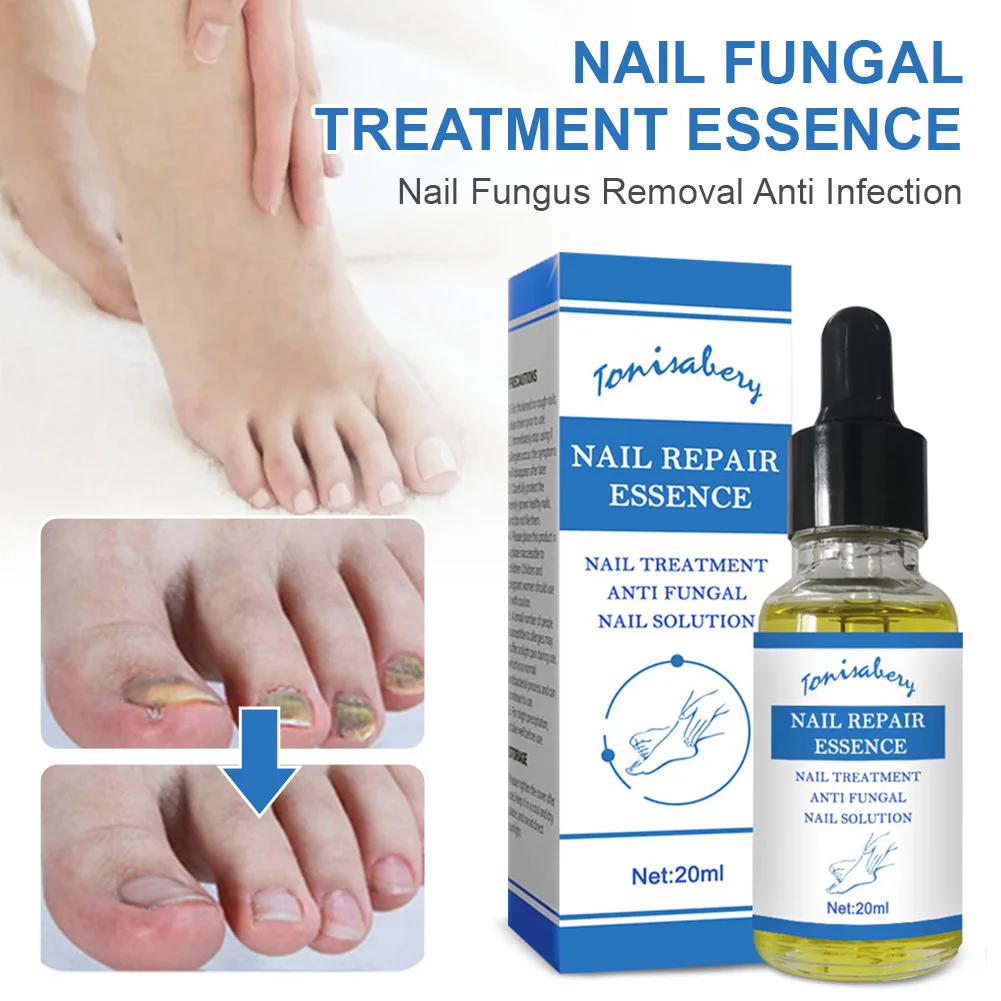 

20ml Nail Fungal Treatment Feet Care Essence Nail Foot Care Toe Nail Fungus Removal Gel Anti Infection Paronychia Onychomycosis