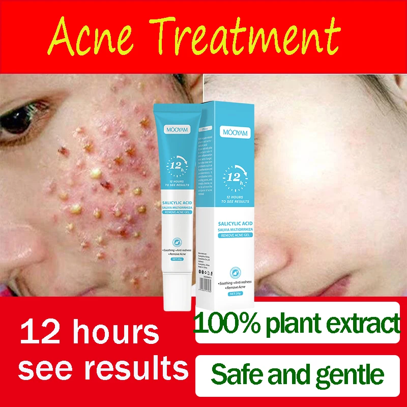 

Salicylic Acid Acne Treatment Face Cream Acne Pimples Removal Shrink Pores Gel Oils Control Moisturizing Herbal Repair Skin Care