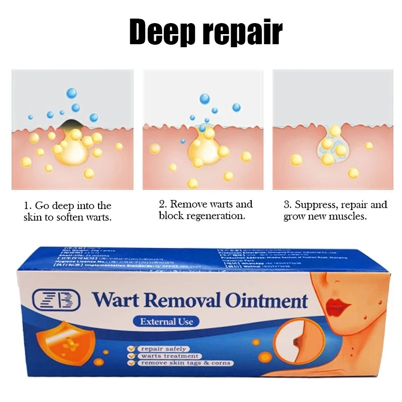 1/3 шт. антибактериальная мазь для удаления бородавок |