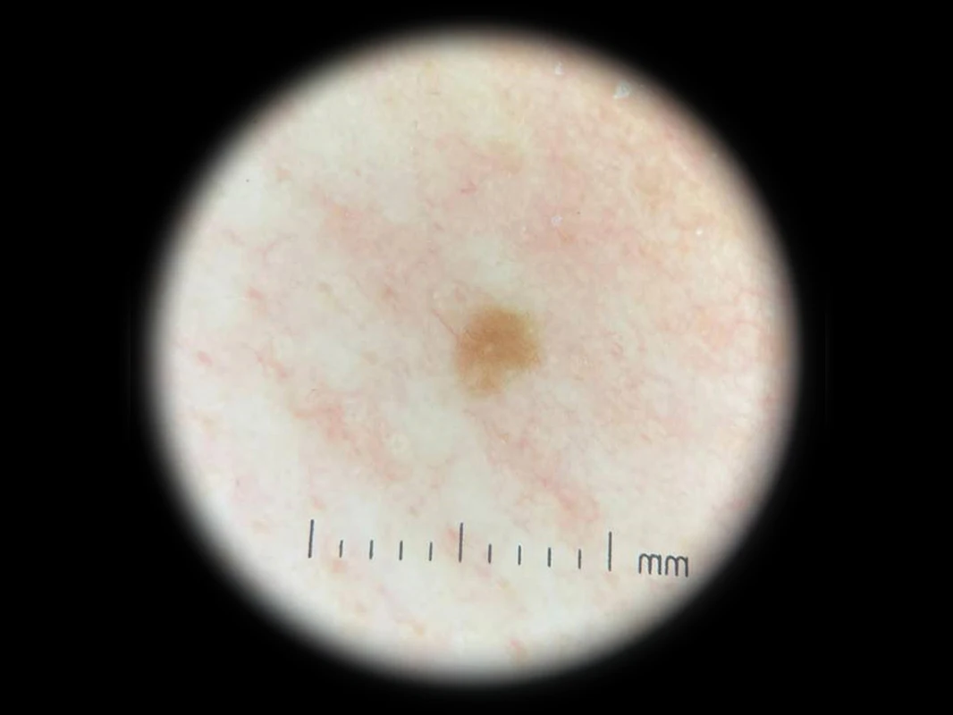 Дерматоскоп IBOOLO DE-300 с Iphone для поляризованной кожи использования в больнице