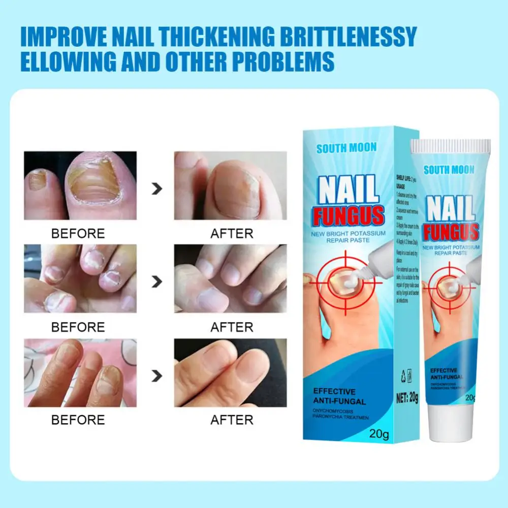 

Effective Nail Therapy Cream Nail Fungus Removal Cream Onychomycosis Paronychia Soft Nail Care Toenail Repair Ointment 20g