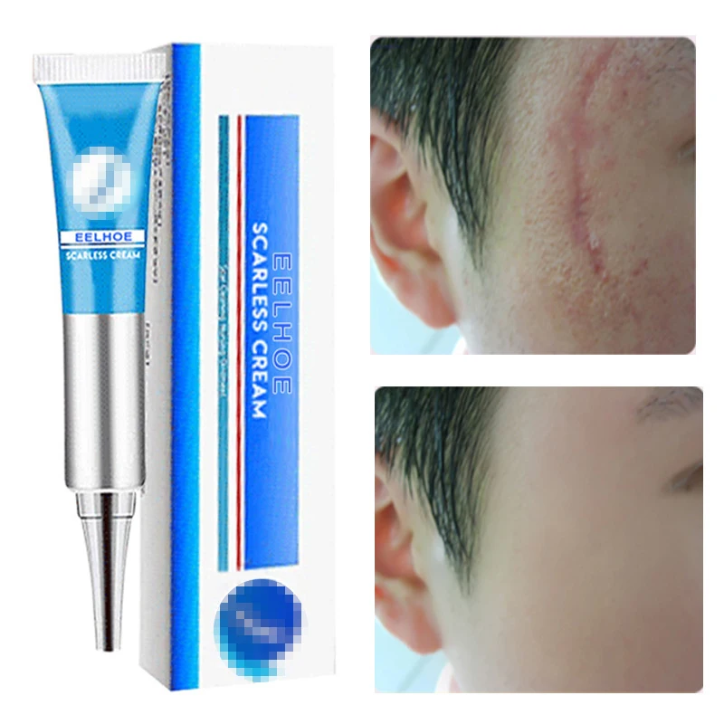 

Effective Scar Stretch Marks Removal Face Cream Acne Pimples Blackhead Burn Scars Remove GelWhitening Body Care Korean Cosmetics