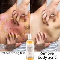 acne body wash remove acne mites anti itch antifungal acne treatment removal mites whitening body wash hilang jerawat