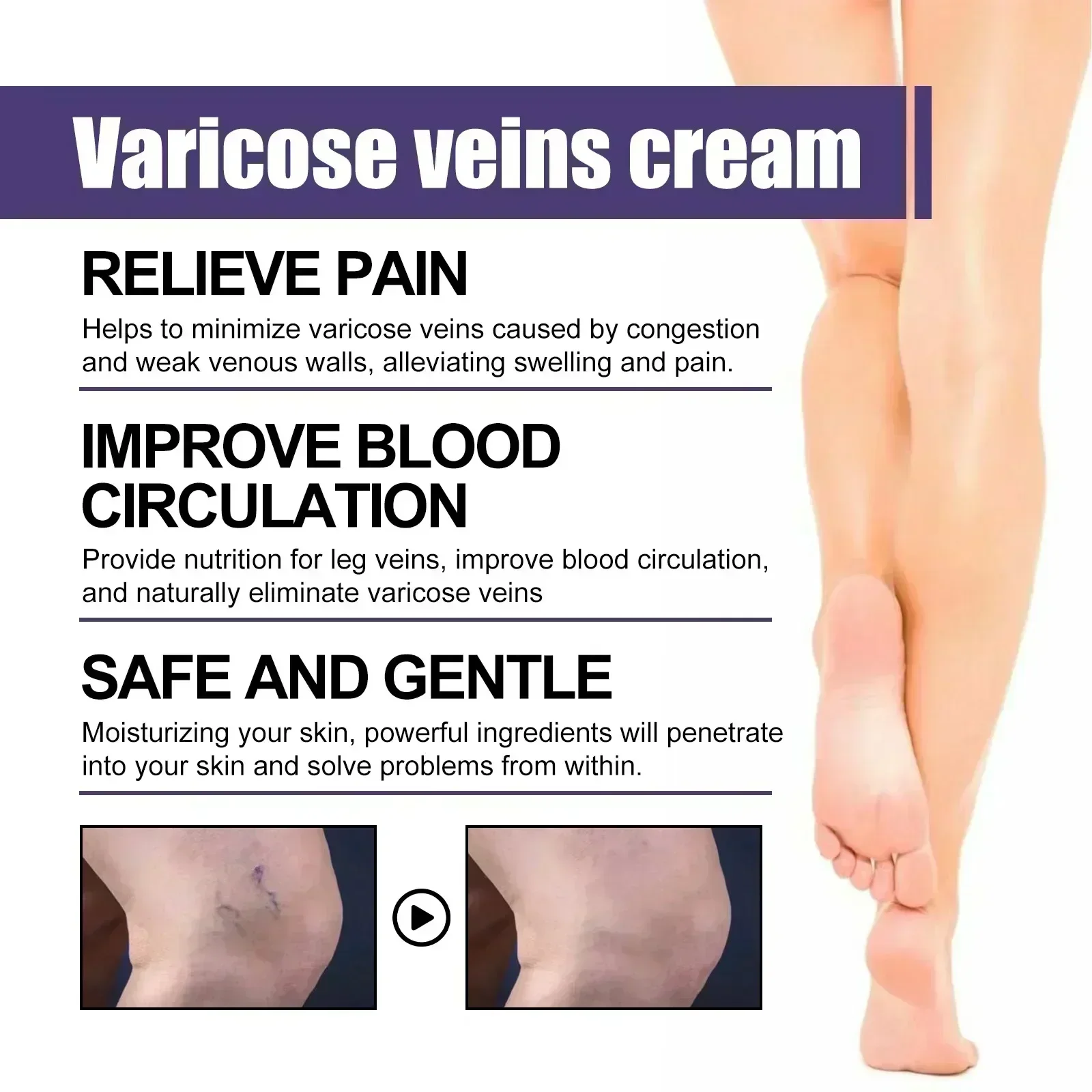 Varicose Veins Relief Cream Leg Vasculitis Phlebitis Spider Shape Vein Pain Ointment Angiitis Removal Body Care Massage10